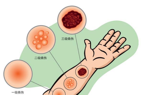 热油烫伤了怎么办？急救知识有哪些？
