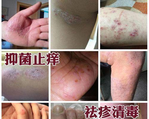 如何彻底治愈日光性皮肤病？一招断根的方法是什么？